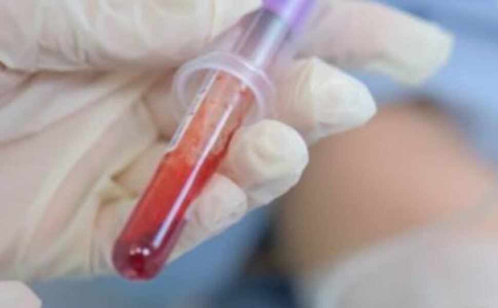 Sindrome Di Down Un Prelievo Di Sangue Per Identificare Alterazioni