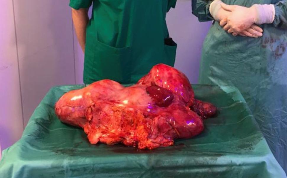 tumore asportato cosenza 7 chili