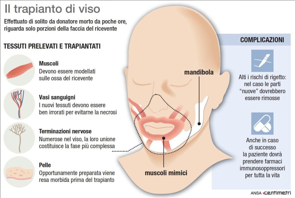Medico di Crotone esegue il primo trapianto di viso in Italia 1 C 2 infografica 1001940 0 image