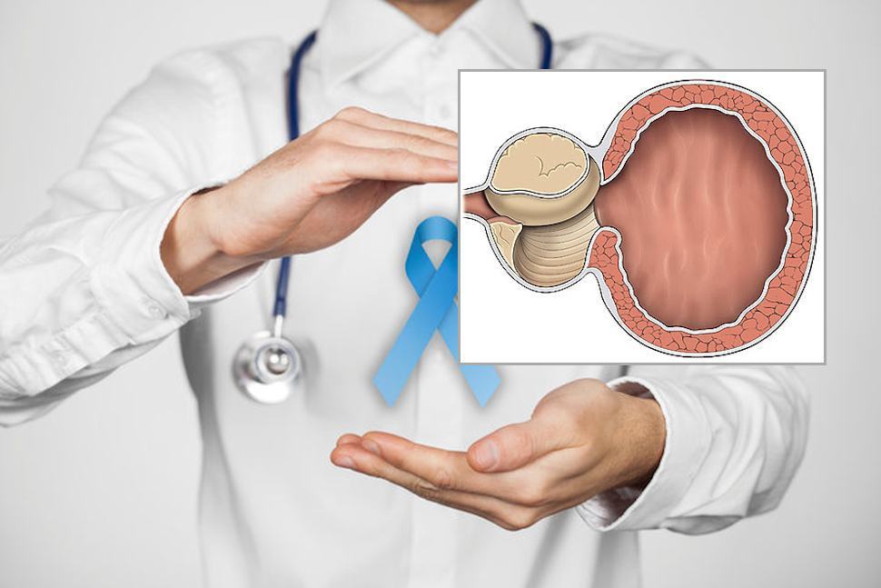 Ipertrofia prostatica benigna