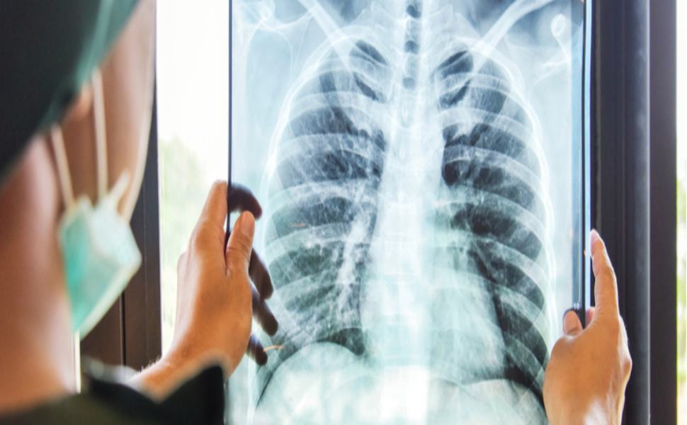 UnaradiografiadeltoracesvelalamalattianeipazientiCOVIDnonsintomatici 1