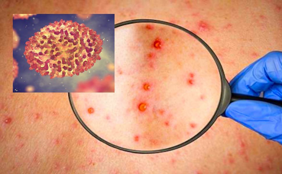 Vaiolo delle Siccime