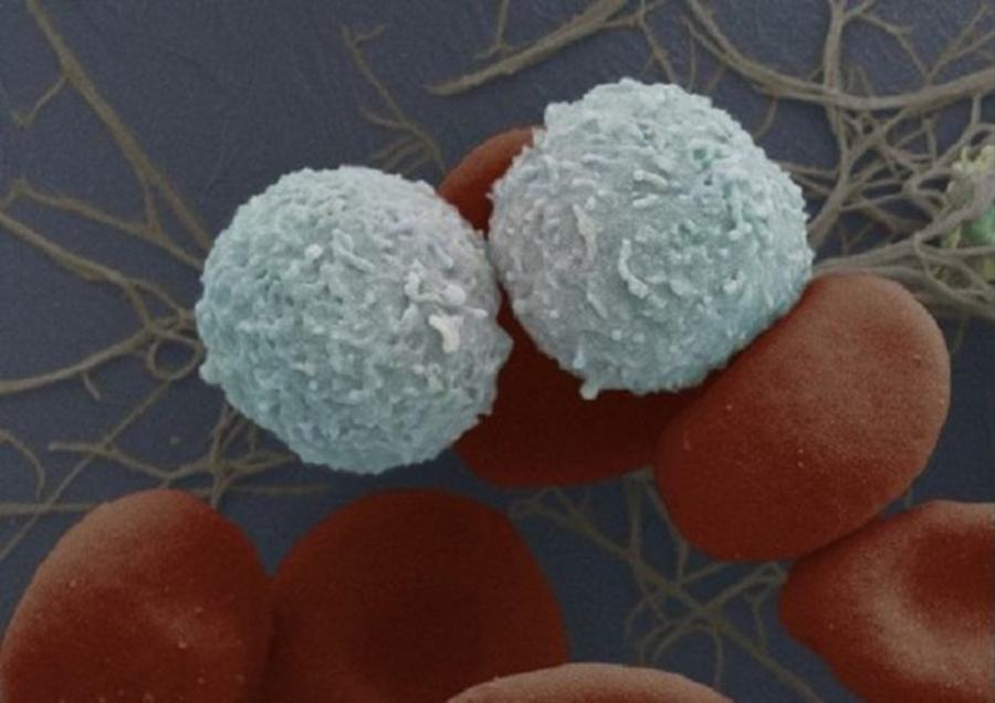 Covid, le staminali riparano le lesioni ai polmoni. Primo caso su un paziente italiano 51 cellule staminali autologhe
