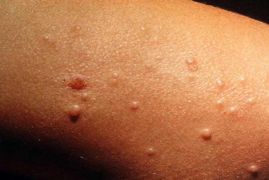 Impetigine ed herpes, malattie della pelle da non sottovalutare 77 dermatosi