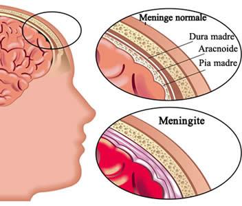 meningite 2