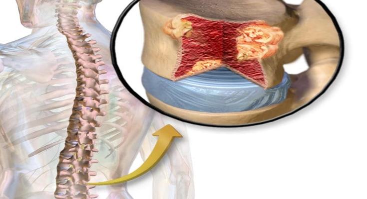 mieloma multiplo 1 1