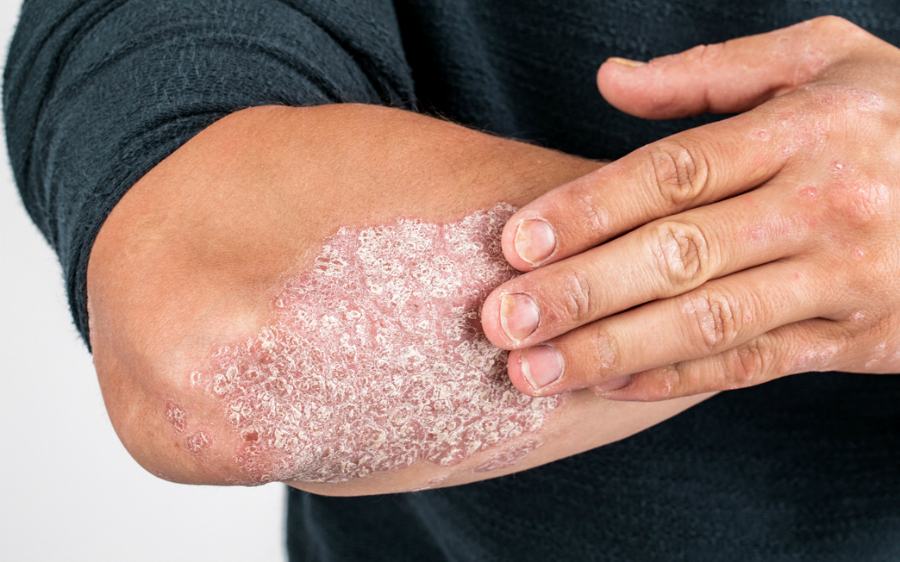 psoriasi 1