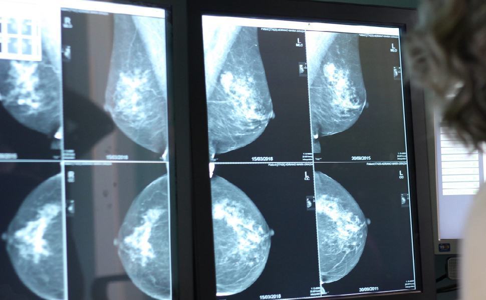 screening mammografico