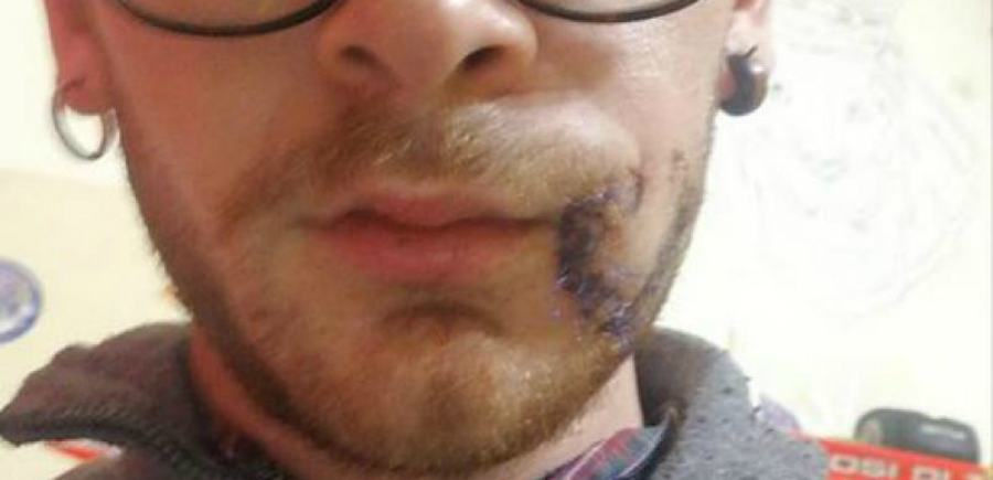 Sfregiato al volto durante una rissa, pubblica la foto su Facebook. Tre arresti 51 sfregiato a catanzaro