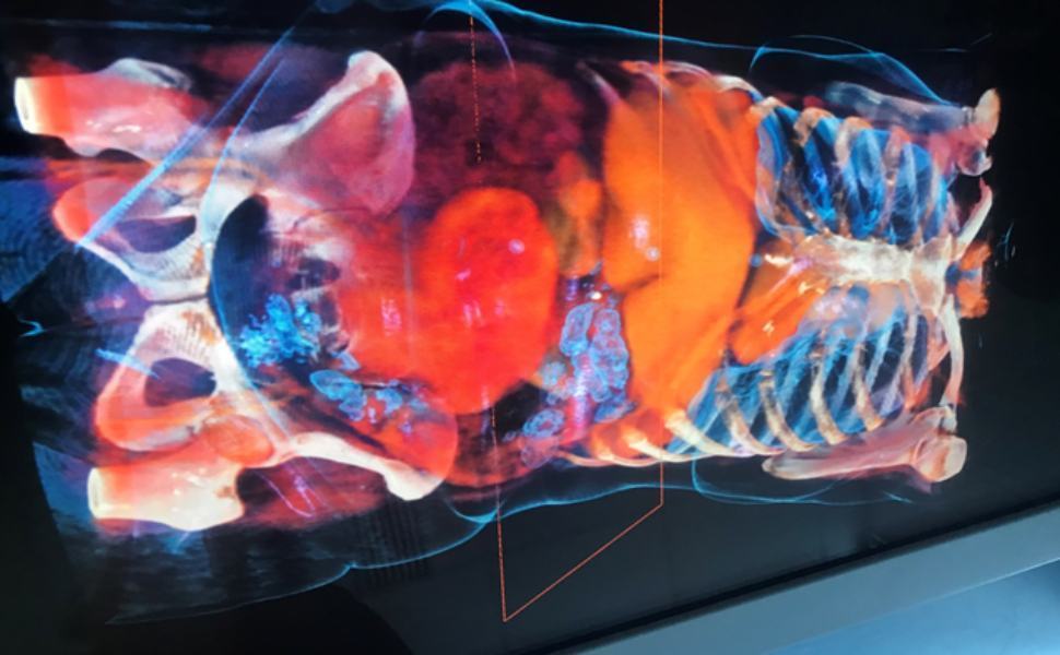 tumore asportato cosenza 7 chili 02