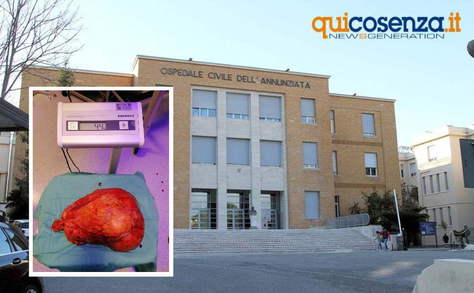 Annunziata, asportato con successo un tumore di 4 chili e mezzo dall'addome di una donna 51 Annunziata tumore 4kg