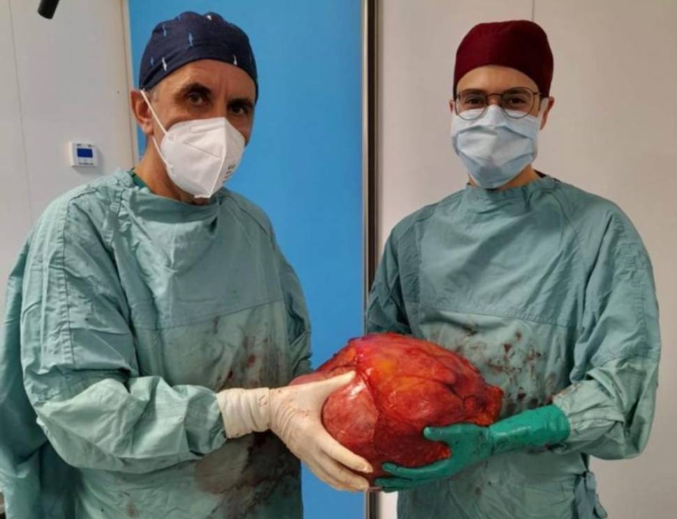 Intervento record a Cosenza: asportato tumore di 10 chili grazie al tavolo 3D dell'Unical 54 tumore 10 chili cosenza annunziata