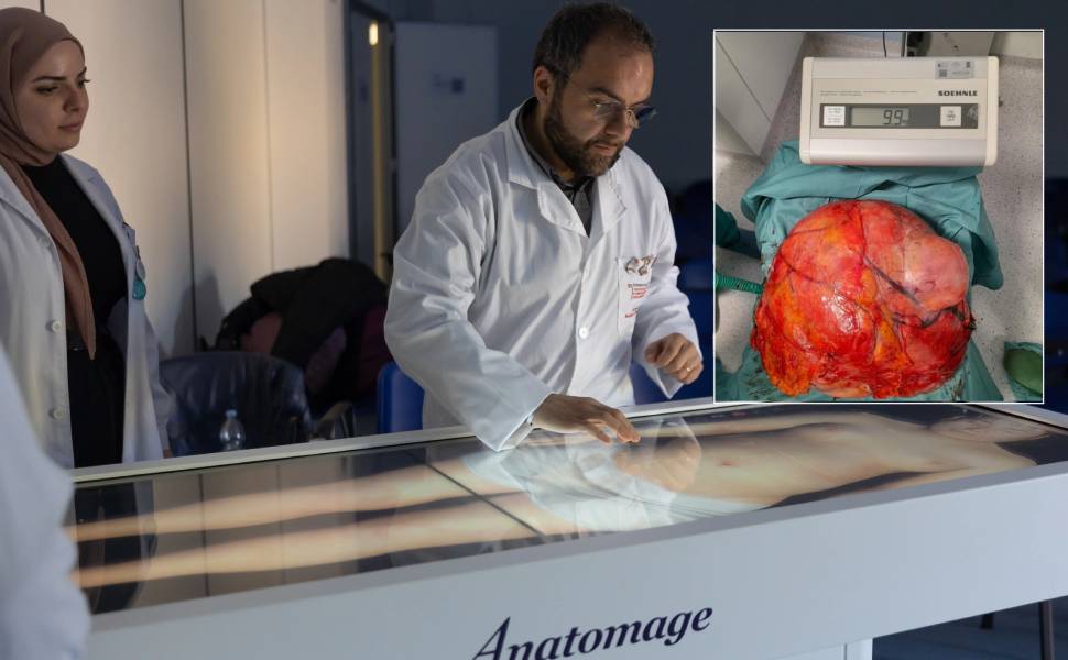 Intervento record a Cosenza: asportato tumore di 10 chili grazie al tavolo 3D dell'Unical 53 tumore 10 chili cosenza e tavolo_anatomico_anatomage