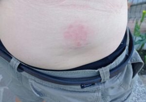 Al Sud caldo infernale senza sosta, al Nord chicchi di grandine come palle da tennis: 110 feriti 55 Feriti grandinew