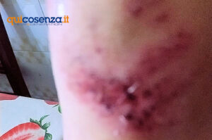 Paura a Cosenza, azzannata da un Pitbull mentre passeggia con il suo cane. Volpino ucciso e donna ferita 54 Aggredita puttbull