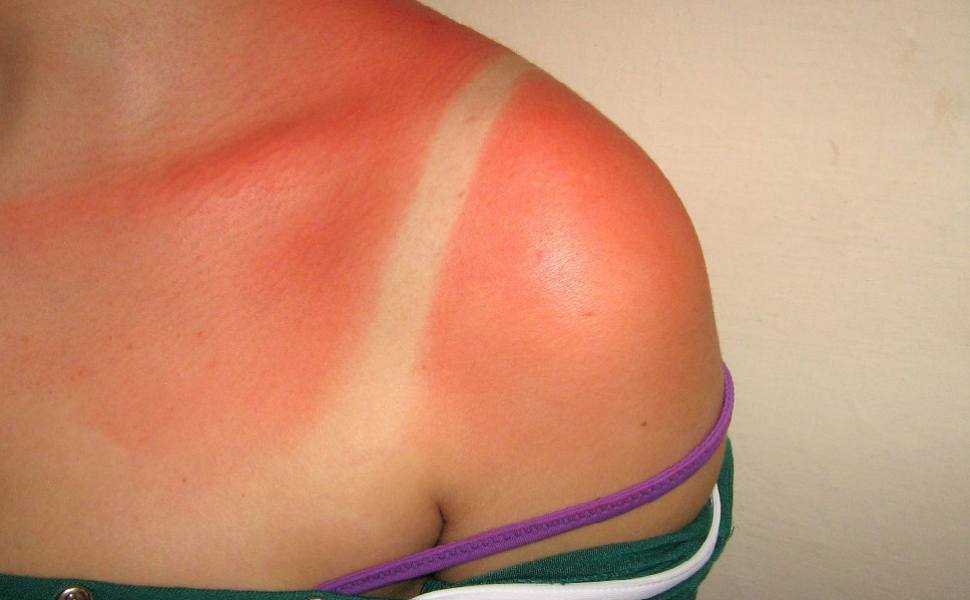 scottature pelle costume estate