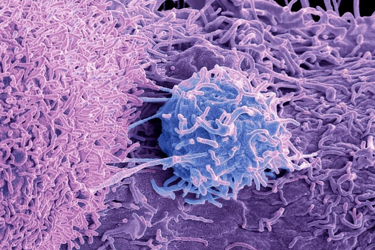 Carcinoma della prostata e biopsia fusion: al Sacro Cuore 10 diagnosi salvavita in poco più di un mese 54 Tumore prostata prospettive aumentare sensibilita radioterapia