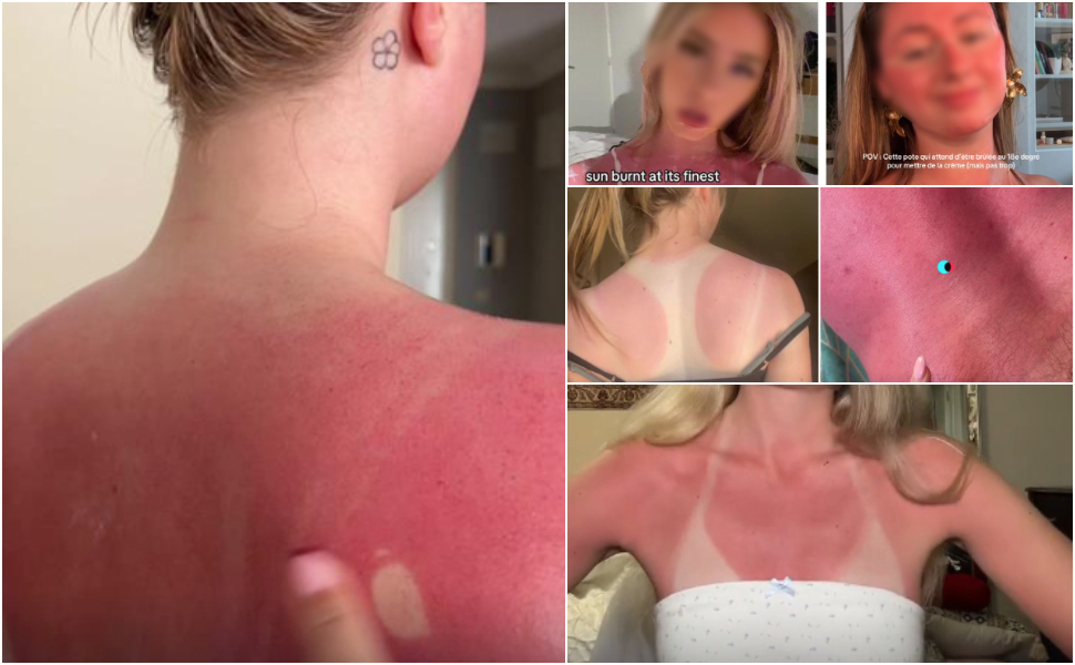 Sunburn challenge