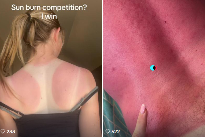 sunburn challenge1