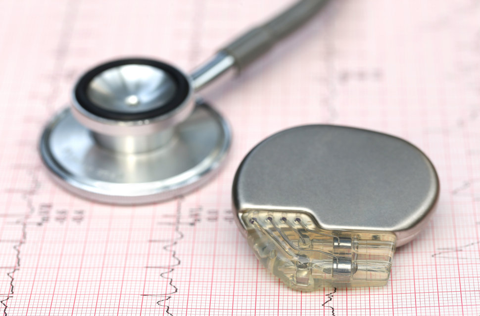 Pacemaker senza fili, all'Asp di Cosenza procedura consolidata: «Decine di impianti ed un primato mondiale» 65 Pacemaker senza fili Asp Cosenza