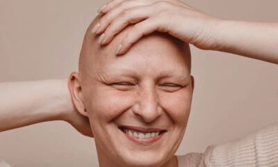 Giornata Nazionale dell'Alopecia Areata Cosenza