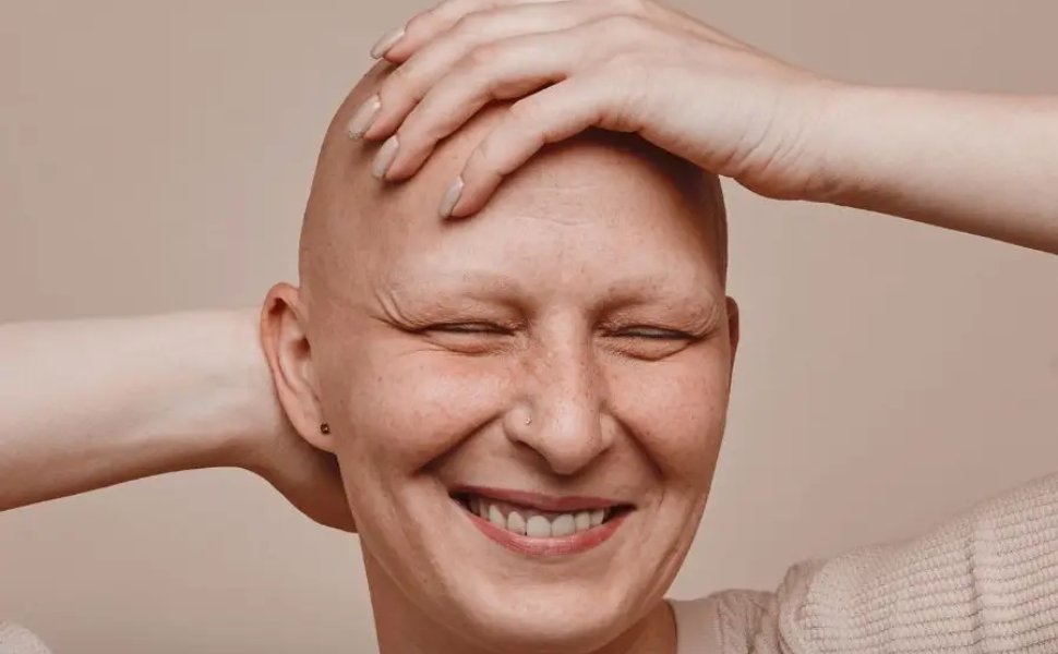 A Cosenza arriva la Giornata Nazionale dell'Alopecia Areata: la battaglia per il riconoscimento ufficiale 51 Giornata Nazionale dell'Alopecia Areata Cosenza