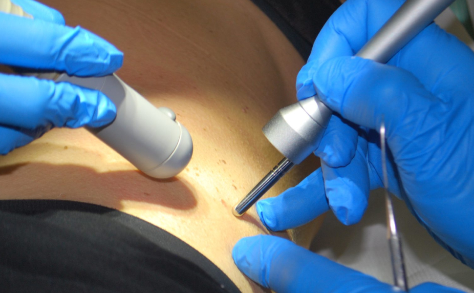 Sanità, apparecchiature sempre più anziane: fino al 50% ha oltre dieci anni 53 Sanità laser chirurgico