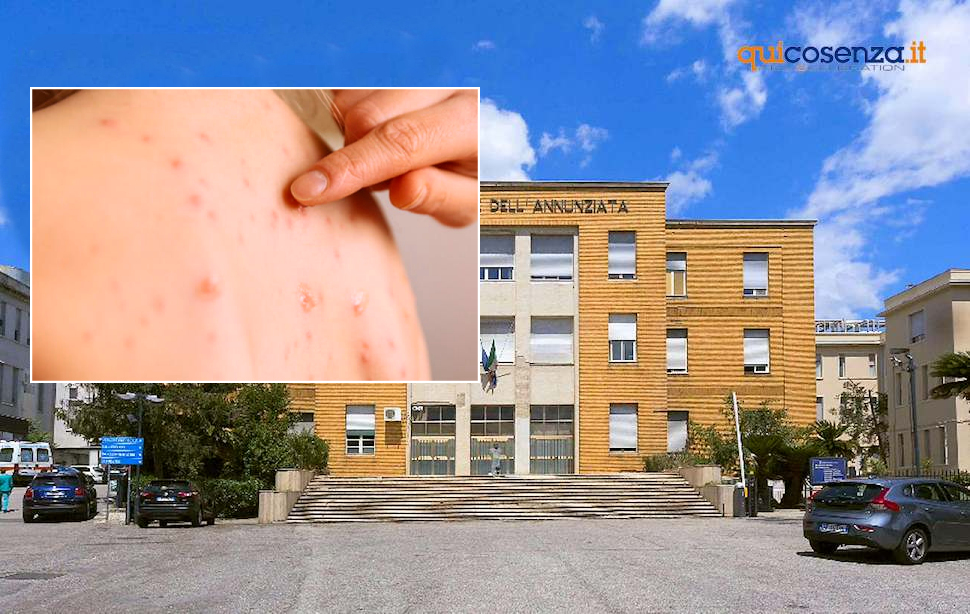 Casi di Morbillo Cosenza