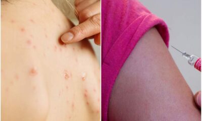 Morbillo_Cosenza_Vaccinazioni