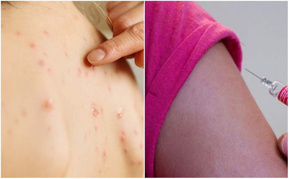 Morbillo_Cosenza_Vaccinazioni