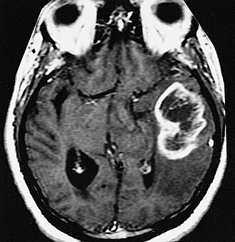 Glioblastoma