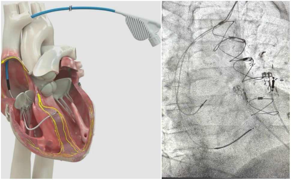 Intervento record all'ospedale di Castrovillari: impiantato il defibrillatore cardiaco con l'elettrocatetere più piccolo al mondo 52 Ospedale di Castrovillari intervento record 2