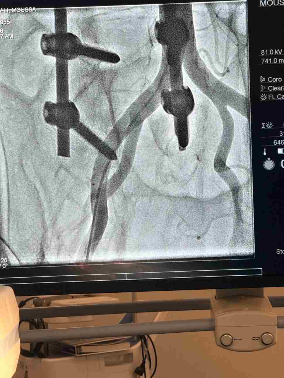Al Giovanni Paolo II inaugurata la sala di cardiologia interventistica: eseguite le prime 2 "procedure zero" 53 Sala di cardiologia interventistica Lamezia 2