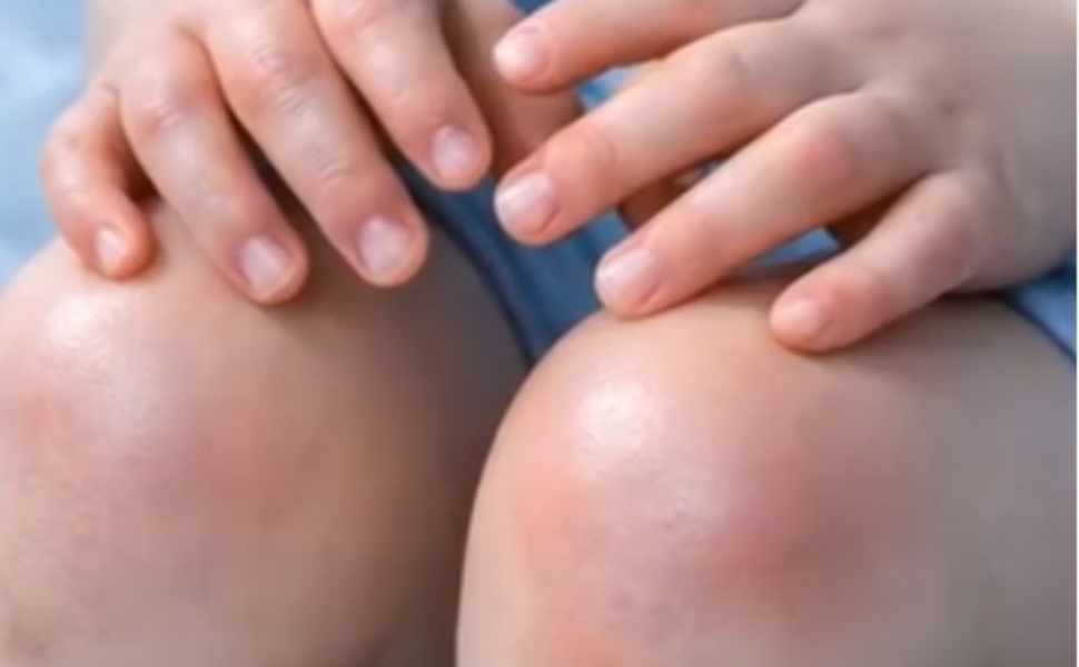 papa figlia cosenza - artrite idiopatica giovanile