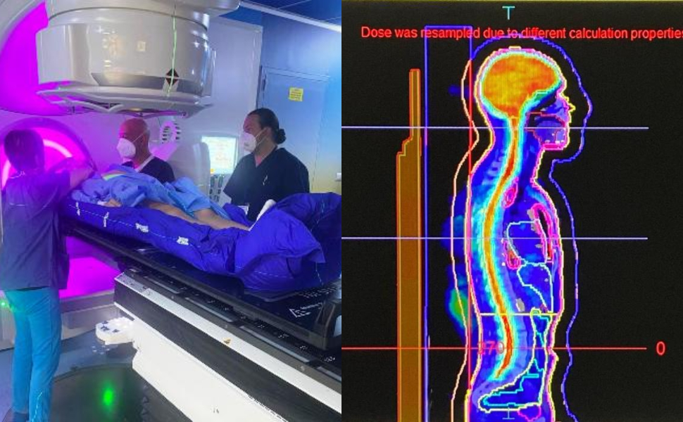 La sofisticata radioterapia che tratta tutto il corpo arriva al Gom: è il primo ospedale in Calabria 51 radioterapia-VMAT-gom-ospedale