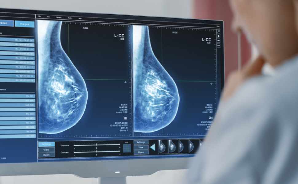 LEA prevenzione carcinoma mammario